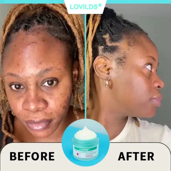 Final Hours—Sale Ending Soon!💥LOVILDS* Renewal Skin Cream | Spot Removal & Skin Renewal for Dark Spots, Age Spots, and Sun Spots* Daily Firming for All Skin Types
