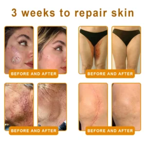 LOVILDS™ 𝘽𝙀𝙀 𝙑𝙀𝙉𝙊𝙈 𝑺𝒌𝒊𝒏 𝑹𝒆𝒔𝒕𝒐𝒓𝒂𝒕𝒊𝒐𝒏 𝑪𝒓𝒆𝒂𝒎 –🌸 Anti-aging,Hydrating, Skin Repair, Even Tone, Acne and Dark Spot Treatment, Wart and Mole Removal, Psoriasis Relief