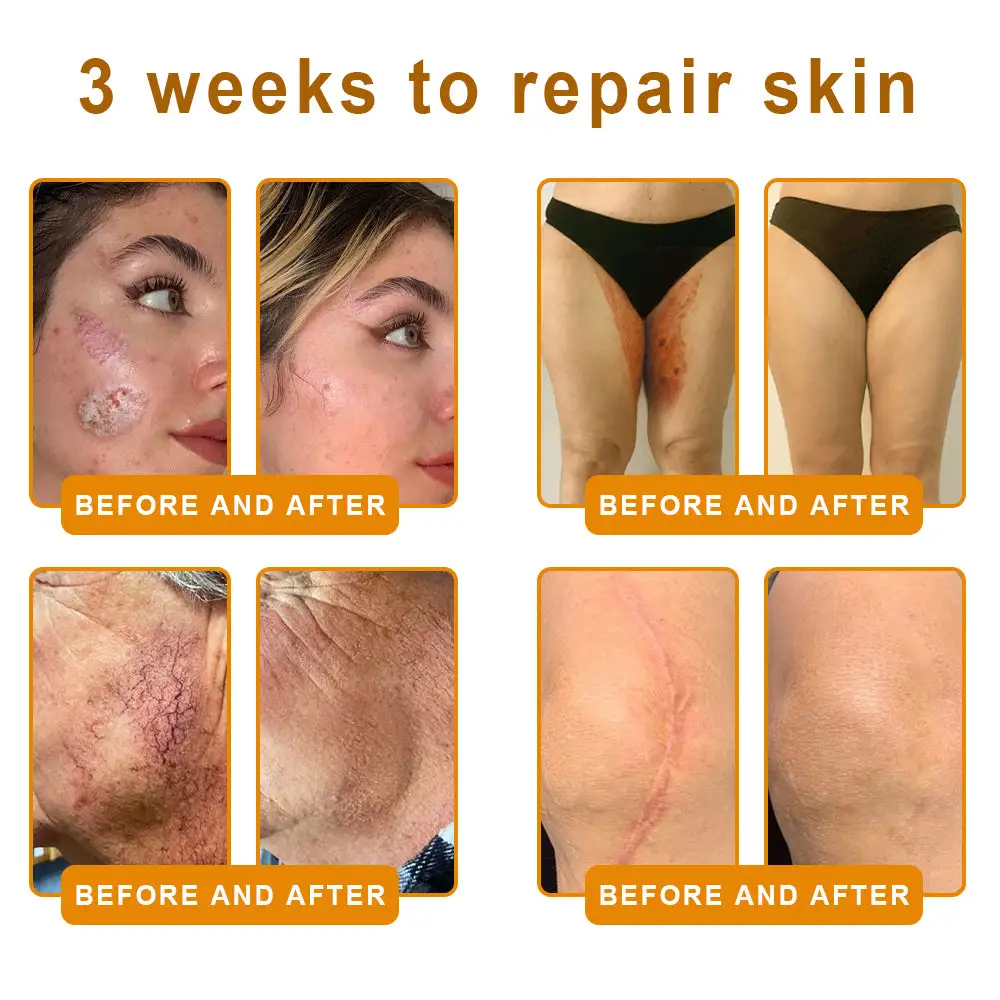 LOVILDS™ 𝘽𝙀𝙀 𝙑𝙀𝙉𝙊𝙈 𝑺𝒌𝒊𝒏 𝑹𝒆𝒔𝒕𝒐𝒓𝒂𝒕𝒊𝒐𝒏 𝑪𝒓𝒆𝒂𝒎 –🌸 Anti-aging,Hydrating, Skin Repair, Even Tone, Acne and Dark Spot Treatment, Wart and Mole Removal, Psoriasis Relief