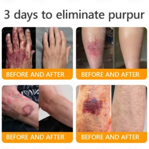LOVILDS™ 𝘽𝙀𝙀 𝙑𝙀𝙉𝙊𝙈 𝑺𝒌𝒊𝒏 𝑹𝒆𝒔𝒕𝒐𝒓𝒂𝒕𝒊𝒐𝒏 𝑪𝒓𝒆𝒂𝒎 –🌸 Anti-aging,Hydrating, Skin Repair, Even Tone, Acne and Dark Spot Treatment, Wart and Mole Removal, Psoriasis Relief