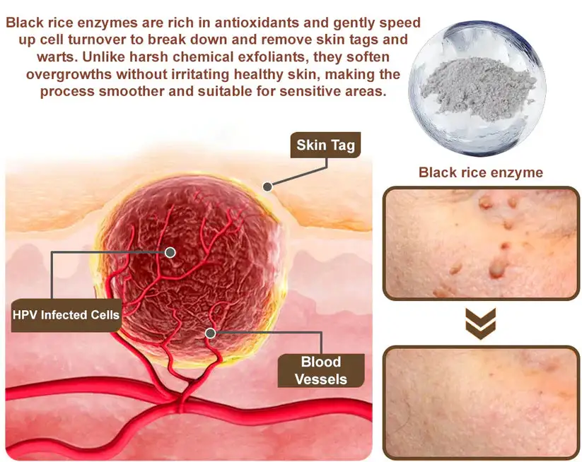 LOVILDS® Black Rice Skin Repair Essence Cream 👨⚕️ MHRA Certified (Removes warts and skin growths, improves keratin buildup and seborrheic dermatitis, follicular keratosis, skin cancer, and age spots)