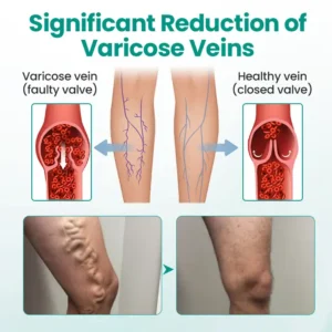 LOVILDS™ LegRenew Varicose Veins Patch