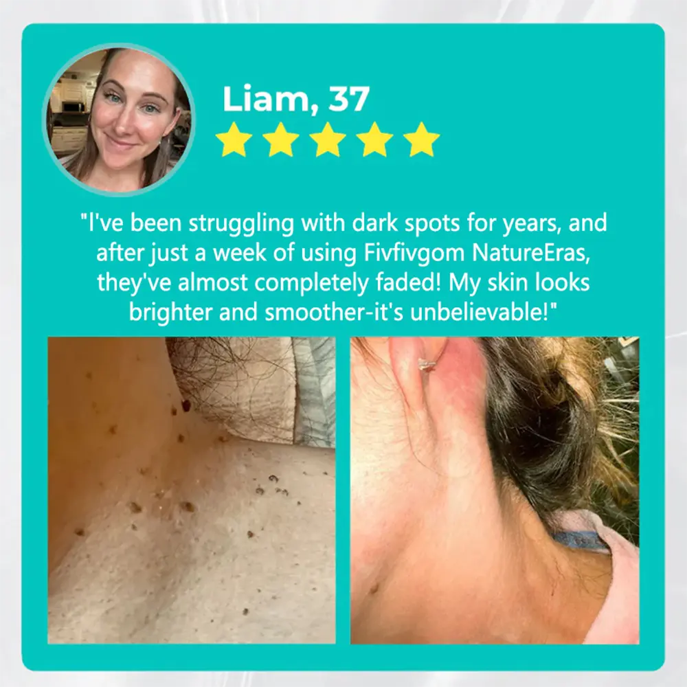🔥(Official retail store) LOVILDS™ NatureErase Instant Mole & Spot Removal Gel