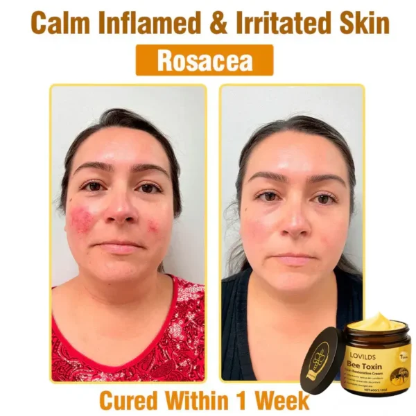 LOVILDS® Bee Toxin  Skin Restoring Cream