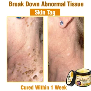 ✨FDA Approved:LOVILDS™  Bee Poison Skin Restoration Cream — 🔥Limited Time 70% OFF🔥