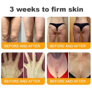 LOVILDS™ 𝘽𝙀𝙀 𝙑𝙀𝙉𝙊𝙈 𝑺𝒌𝒊𝒏 𝑹𝒆𝒔𝒕𝒐𝒓𝒂𝒕𝒊𝒐𝒏 𝑪𝒓𝒆𝒂𝒎 –🌸 Anti-aging,Hydrating, Skin Repair, Even Tone, Acne and Dark Spot Treatment, Wart and Mole Removal, Psoriasis Relief