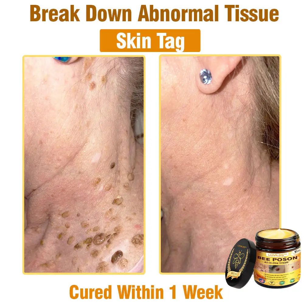 LOVILDS™ BEE POSON All-in-One Cream US Dermatologist Approved