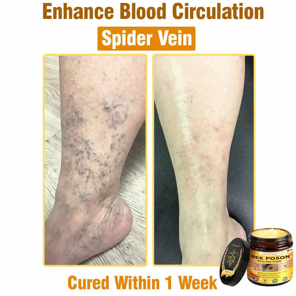 LOVILDS™ BEE POSON All-in-One Cream US Dermatologist Approved