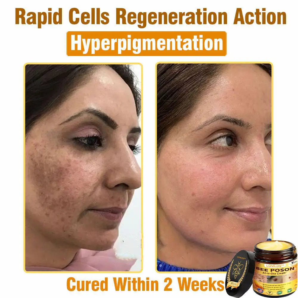 LOVILDS™ BEE POSON All-in-One Cream US Dermatologist Approved