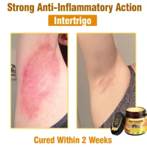 LOVILDS™ Bee Poison All-in-One Cream US Dermatologist Approved