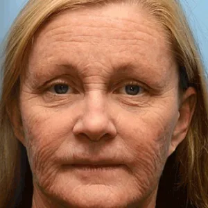 🧑‍⚕️LOVILDS® Botox Bee Venom Wrinkle Removal Cream (Made and Shipped from USA)