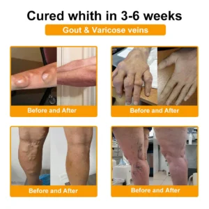 LOVILDS™ Botulinum Toxin & Bee Poison Pain-Relief Bone Healing Cream