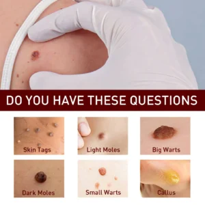 LOVILDS™ LIQUID WART FLAT This mole and wart removal cream gently cleanses, repairs, and softens the skin on your hands, feet, face, and neck.(1)