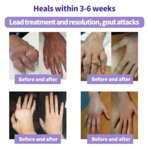 ⏰Last Day Promotion: BUY 1 GET 1 FREE🔥Lovilds™ Turmeric & Emu Oil Arthritis Soothing Pain Relief Massage Gel 👨⚕️Australian Osteopathic Association (AOA)Approved