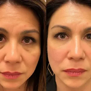 Lovilds™ Eye Roller for Puffiness | Removes 97% of under-eye bags in 60 seconds — Instantly look 10 years younger!