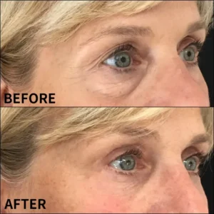 Lovilds™ Eye Roller for Puffiness | Removes 97% of under-eye bags in 60 seconds — Instantly look 10 years younger!