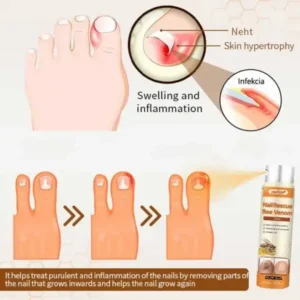 Lovilds® NailRescue Včelí jed ve spreji