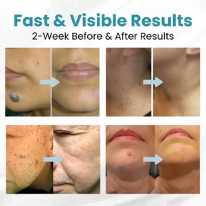 🔥【OFFICIAL STORE】LOVILDS™ Non-Invasive Mole and Wart Removal Laser Pen