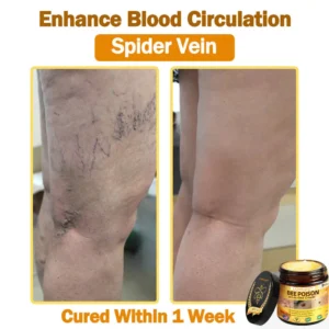 [𝐎𝐟𝐟𝐢𝐜𝐢𝐚𝐥 𝐁𝐫𝐚𝐧𝐝 𝐒𝐭𝐨𝐫𝐞] 🐝 LOVILDS™ 𝐁𝐞𝐞 Poison 𝐀𝐥𝐥-𝐢𝐧-𝐎𝐧𝐞 𝐂𝐫𝐞𝐚𝐦 (👩‍⚕️ 𝐀𝐦𝐞𝐫𝐢𝐜𝐚𝐧 𝐀𝐜𝐚𝐝𝐞𝐦𝐲 𝐨𝐟 𝐃𝐞𝐫𝐦𝐚𝐭𝐨𝐥𝐨𝐠𝐲 𝟐𝟎𝟐𝟓 𝐒𝐩𝐞𝐜𝐢𝐚𝐥𝐥𝐲 𝐑𝐞𝐜𝐨𝐦𝐦𝐞𝐧𝐝𝐞𝐝 𝐏𝐫𝐨𝐝𝐮𝐜𝐭)