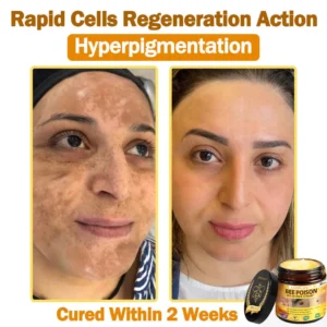 [𝐎𝐟𝐟𝐢𝐜𝐢𝐚𝐥 𝐁𝐫𝐚𝐧𝐝 𝐒𝐭𝐨𝐫𝐞] 🐝 LOVILDS™ 𝐁𝐞𝐞 Poison 𝐀𝐥𝐥-𝐢𝐧-𝐎𝐧𝐞 𝐂𝐫𝐞𝐚𝐦 (👩‍⚕️ 𝐀𝐦𝐞𝐫𝐢𝐜𝐚𝐧 𝐀𝐜𝐚𝐝𝐞𝐦𝐲 𝐨𝐟 𝐃𝐞𝐫𝐦𝐚𝐭𝐨𝐥𝐨𝐠𝐲 𝟐𝟎𝟐𝟓 𝐒𝐩𝐞𝐜𝐢𝐚𝐥𝐥𝐲 𝐑𝐞𝐜𝐨𝐦𝐦𝐞𝐧𝐝𝐞𝐝 𝐏𝐫𝐨𝐝𝐮𝐜𝐭)