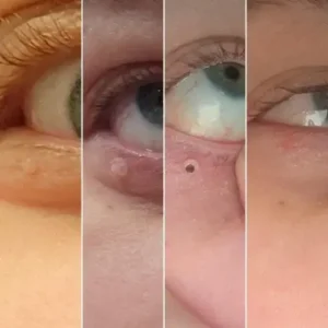 LOVILDS® – Skin Wart & Skin Tag Removal Kit