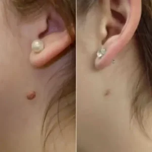 LOVILDS® – Skin Wart & Skin Tag Removal Kit