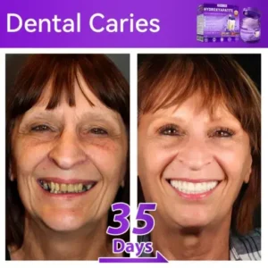 Lovilds® 𝐻𝑦𝑑𝑟𝑜𝑥𝑦𝑎𝑝𝑎𝑡𝑖𝑡𝑒 𝑇𝑜𝑜𝑡ℎ 𝑅𝑒𝑠𝑡𝑜𝑟𝑎𝑡𝑖𝑣𝑒 𝑃𝑜𝑤𝑑𝑒𝑟