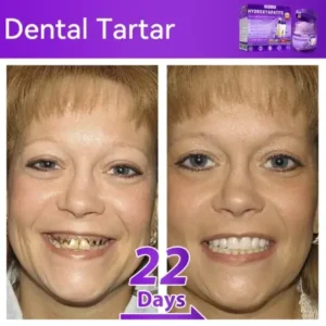 Lovilds® 𝐻𝑦𝑑𝑟𝑜𝑥𝑦𝑎𝑝𝑎𝑡𝑖𝑡𝑒 𝑇𝑜𝑜𝑡ℎ 𝑅𝑒𝑠𝑡𝑜𝑟𝑎𝑡𝑖𝑣𝑒 𝑃𝑜𝑤𝑑𝑒𝑟