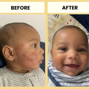 LOVILDS® Honey Eczema Cream